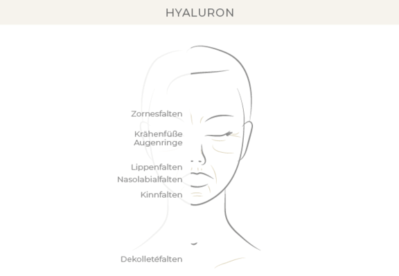 Hyaluron, Dr. Eugenia Remmel, Plastische Chirurgie Zürich