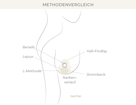 Brustverkleinerung, Dr. Eugenia Remmel, Plastische Chirurgie Zürich