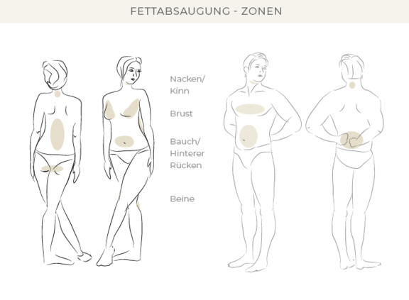 Fettabsaugung, Dr. Eugenia Remmel, Plastische Chirurgie Zürich